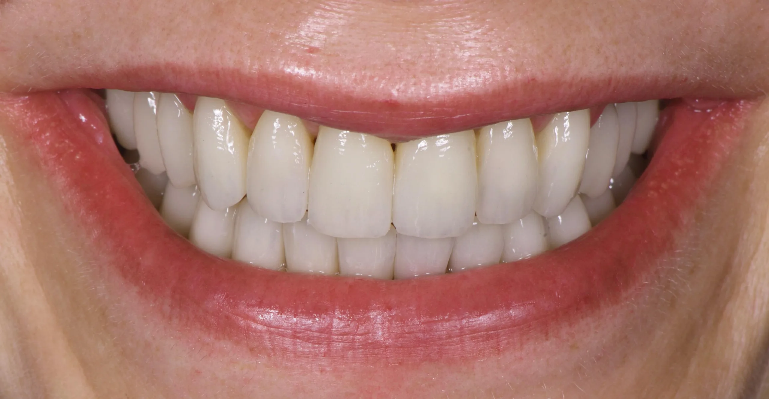 Veneers nachher